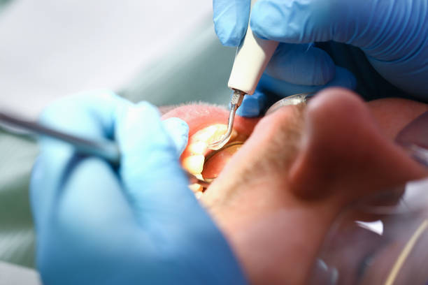 Best Emergency Dentist for Lost Fillings or Crowns in Monterey Park, CA